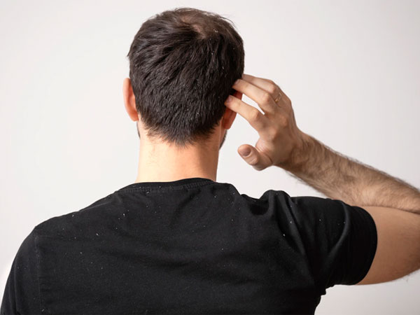 protect hair from dandruff Hair loss in men 