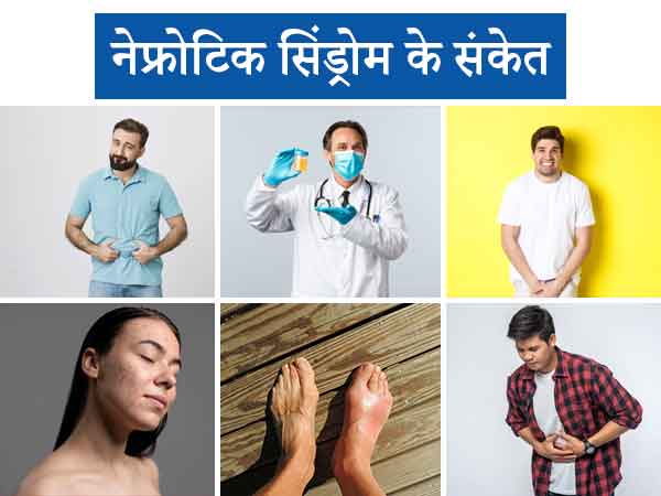 नेफ्रोटिक सिंड्रोम के संकेत Symptoms causes and treatment of nephrotic syndrome in children