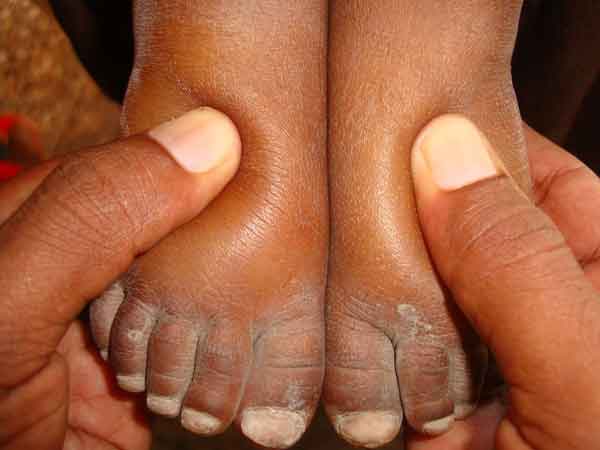नेफ्रोटिक-सिंड्रोम Symptoms causes and treatment of nephrotic syndrome in children