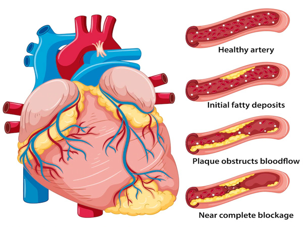 coronary artery disease (Heart Failure in Hindi)
