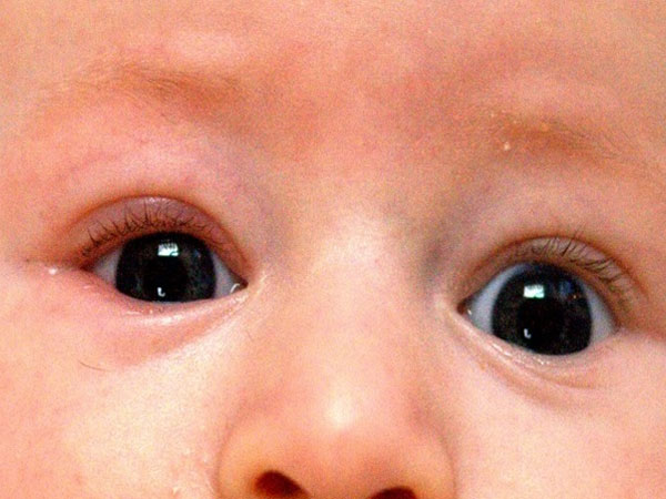 blepharitis Redness In Eyes