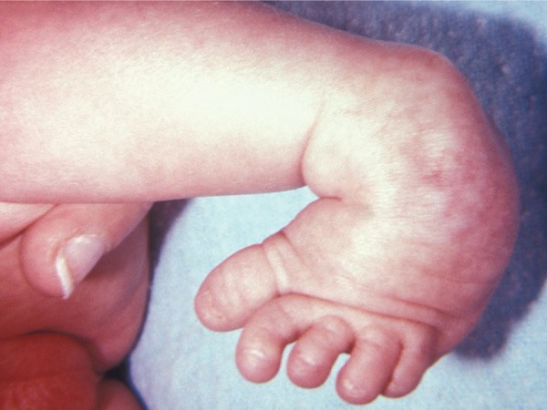 क्लब फुट क्या होता है? – What is clubfoot in Hindi