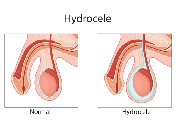 Causes-of-Hydroce
