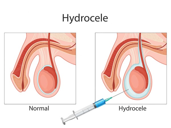Diagnosis-of-Hydrocele