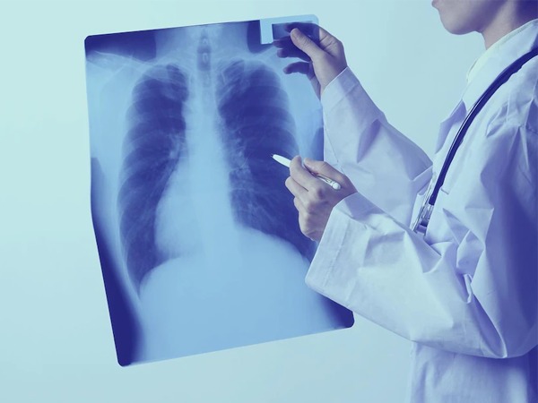 Diagnosis-of-TB