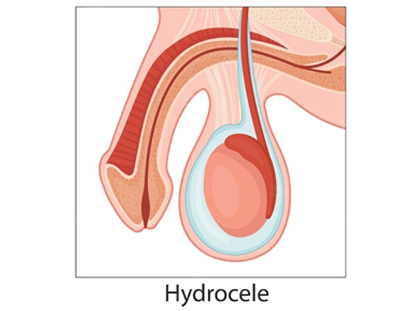 what is Hydrocele