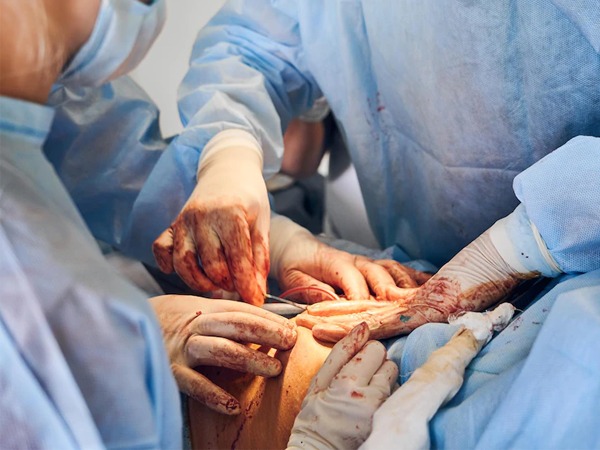Hydrocelectomy-Surgery