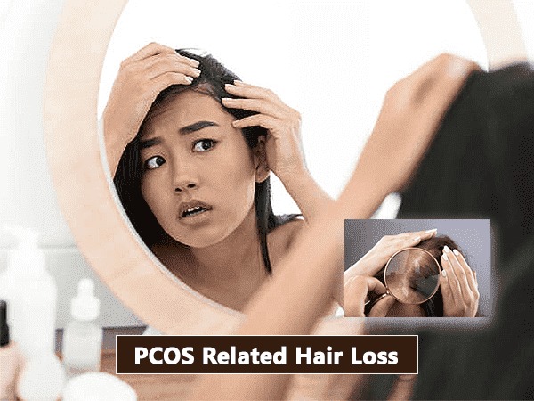PCOS Related Hair Loss