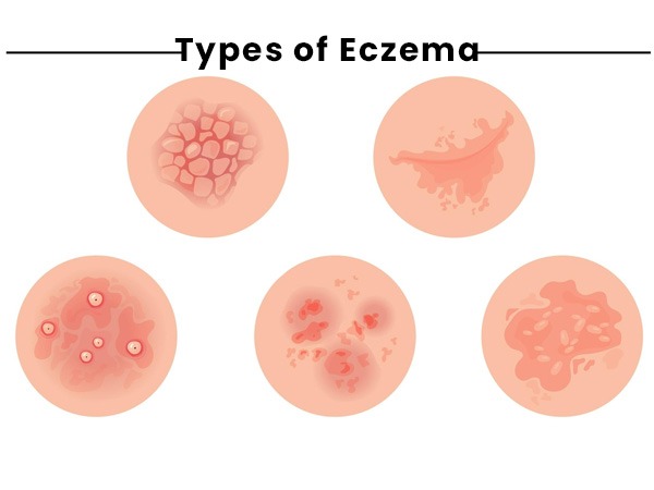 एक्जिमा के प्रकार - Types of Eczema in Hindi