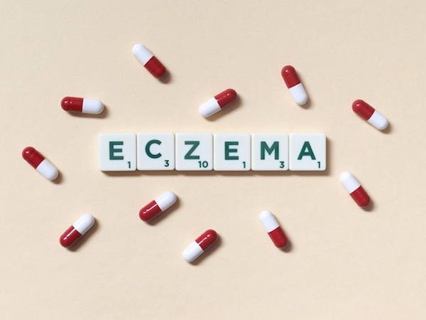 एक्जिमा को कैसे रोका जा सकता है? Prevention of Eczema in Hindi