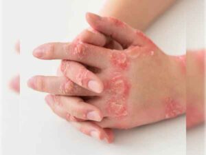 Eczema Scars What All You Should Know