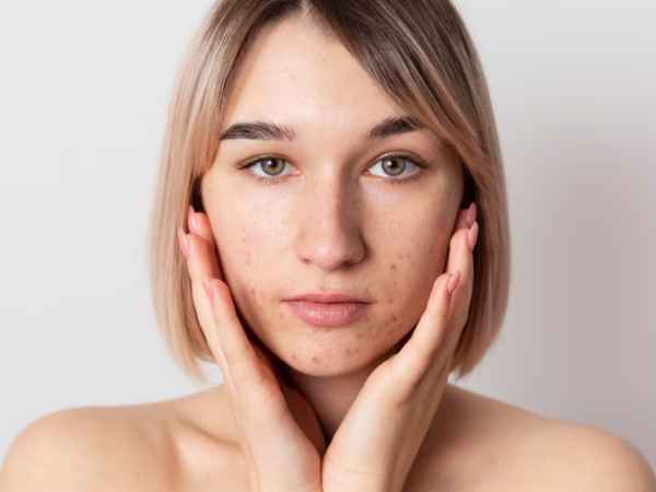 The-Connection-Between-Stress-and-Acne-4-Ways-to-Keep-It-Under-Control
