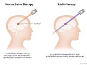 Proton Beam Therapy