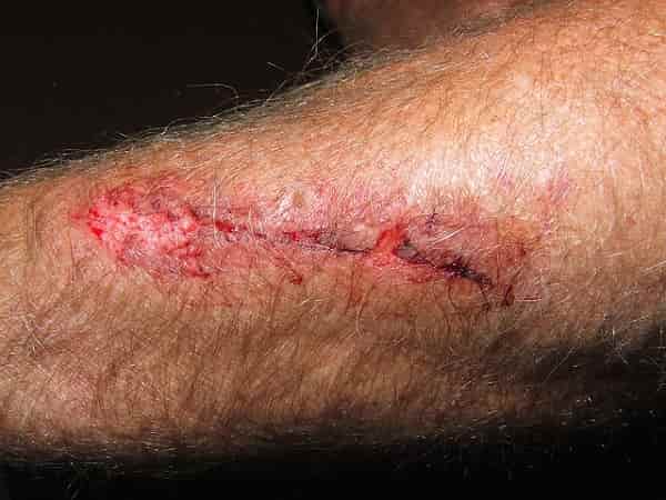 Slow healing of a wound or injury | In Diabetes