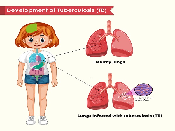 lung tuberculosis Tuberculosis (TB) Explained by AIIMS Doctor Deepak Agrawal