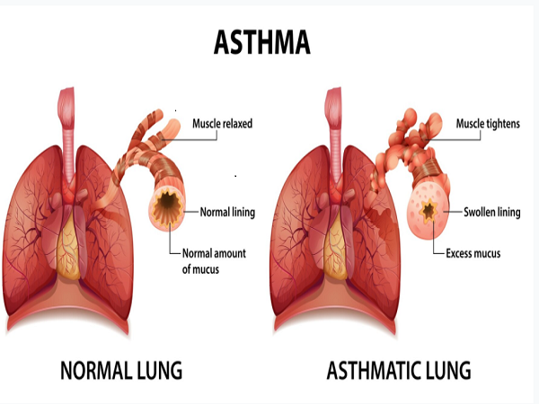 Allergic Rhinitis (Allergies) | Asthma |