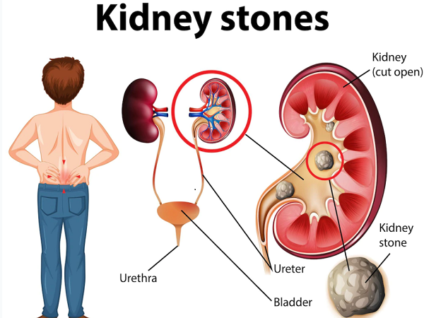 Uric Acid: Increase in uric acid can increase the risk of kidney stones