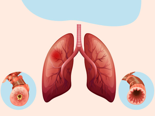 Emphysema 8 Types of Respiratory Diseases 