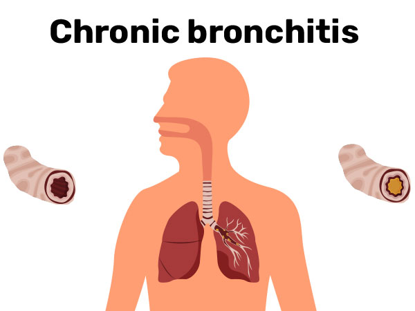 Chronic bronchitis