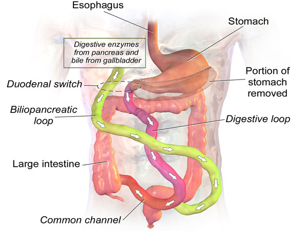 Duodenal-switch