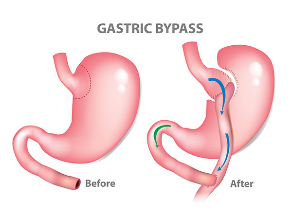 Gastric bypass