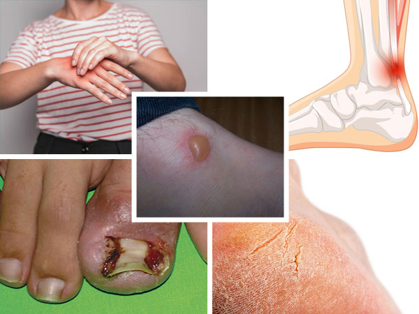 symptoms of a Diabetic Foot