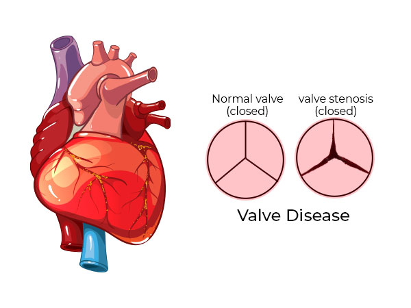 Rheumatic Heart disease