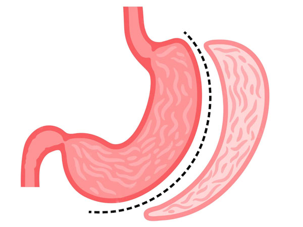 Sleeve gastrectomy