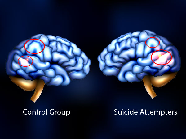 Suicidal Brain Vs Normal Brain (Suicide)