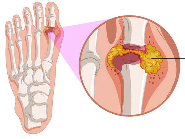 How to Deal With High Uric Acid (Uric Acid symptoms)