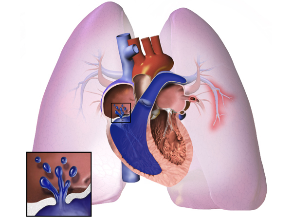 Arterial Hypertension