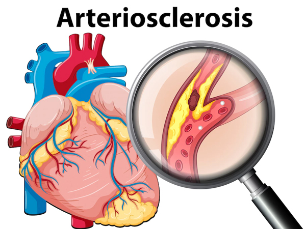 Atherosclerosis