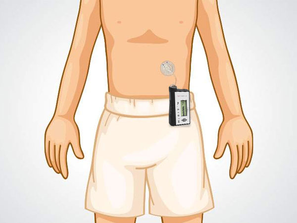 Insulin Pump Therapy