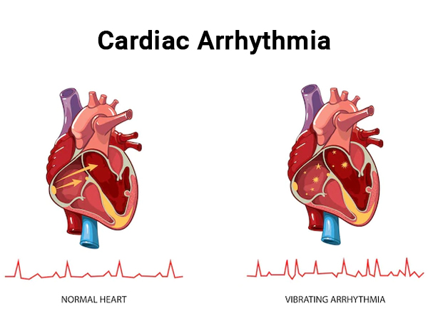 Cardiac Arrhythmia