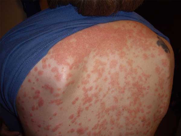 Guttate-type psoriatic