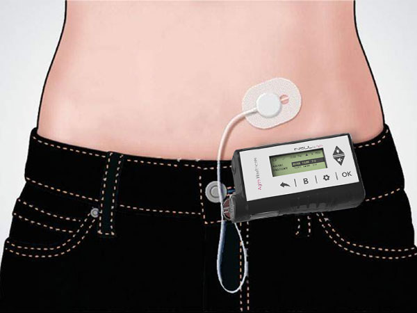 Insulin Pump Uses and Functions to Manage Diabetes