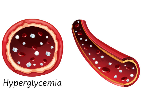 Hyperglycemia