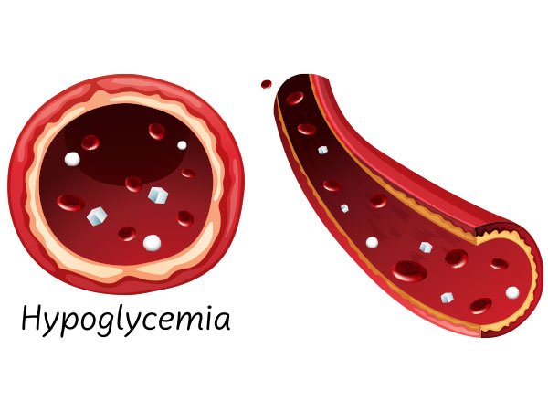 Hypoglycemia