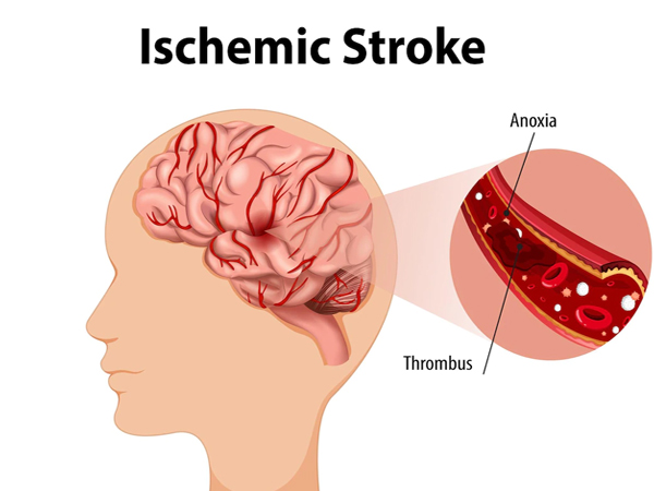 Ischaemic Stroke Patients