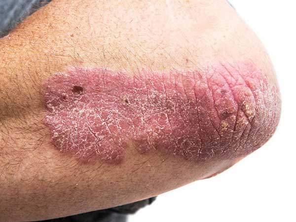 Plaque-type psoriasis