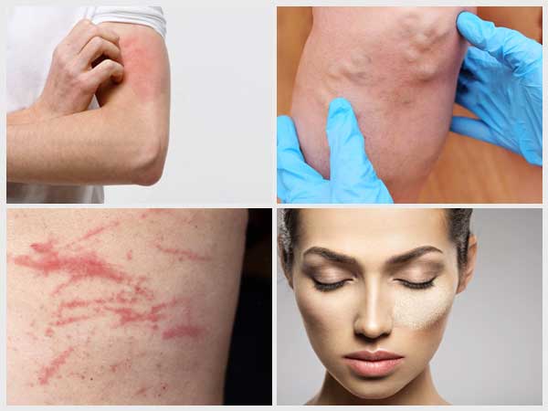 symptoms of psoriasis