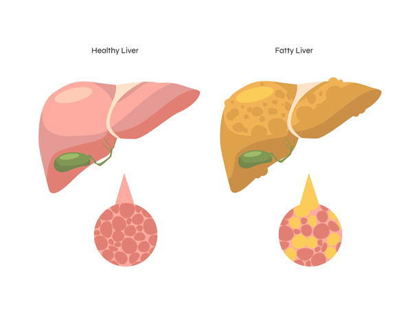 Fatty Liver