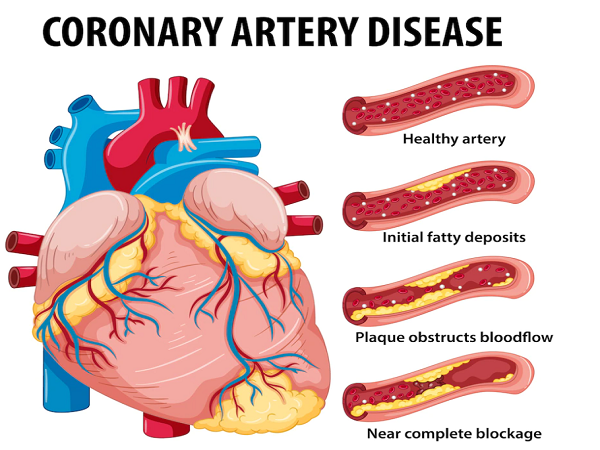 Heart Attack First Aid for Coronary Artery Disease