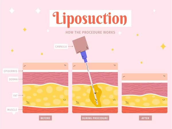 The-Procedure-How-does-liposuction-work