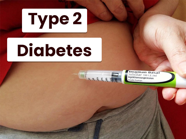 Type 2 Diabetes