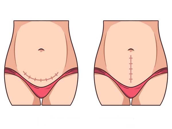 Types-of-abdominoplastic-surgery