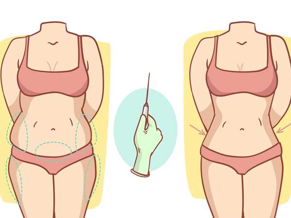 Understanding-Liposuction