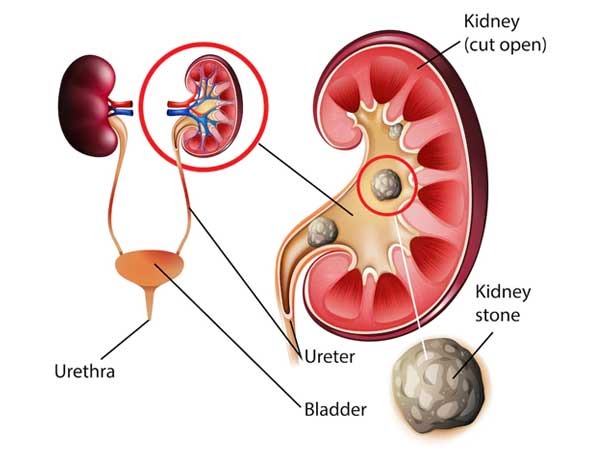 What-are-Kidney-stones-A-General-overview-of-the-disease