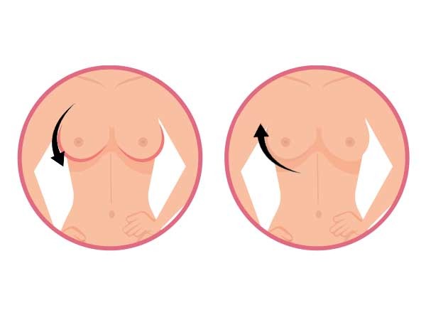 What-causes-Sagging-breasts