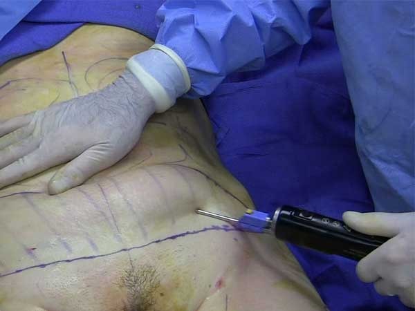 What-to-do-if-your-Liposuction-surgery-goes-wrong